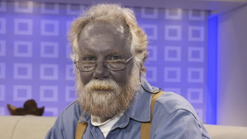Famously-blue Paul Karason was known as “Papa Smurf” (photo above). He developed his azure hue from drinking a concoction of silver nanoparticles, a practice which he thought would improve his health.