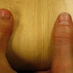 A BDD thumb (left) and a normal thumb (right)
